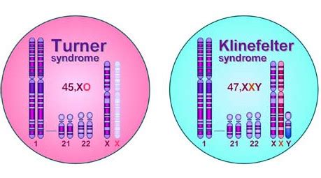 Turner Vs Klinefelter Syndrome