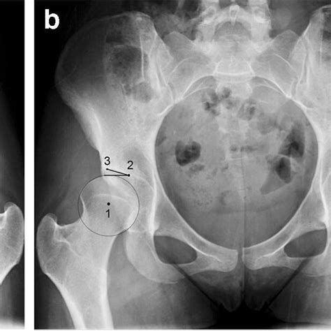 Severe Bilateral Hip Dysplasia In A 19 Year Old Woman A Download