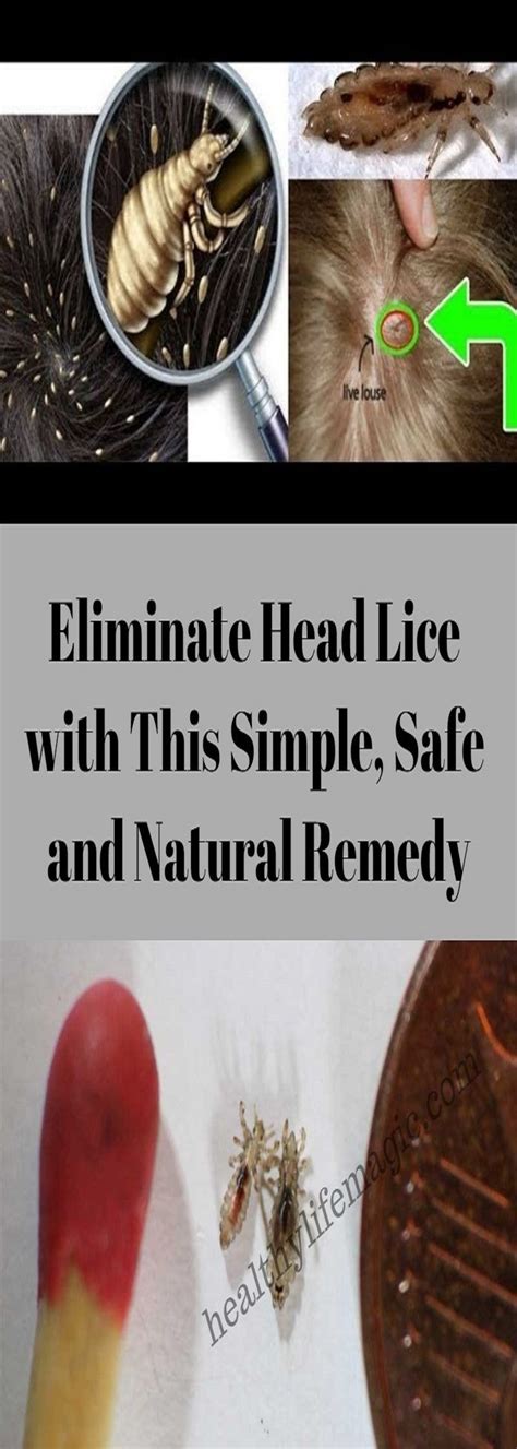 Eliminate Head Lice With This Simple Safe And Natural Remedy Healthy