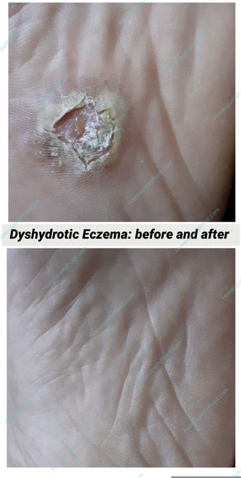 Cure Of Dyshidrotic Eczema With Homeopathy Homeopathypoint