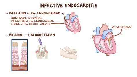 Clinical Reasoning Infective Endocarditis Osmosis