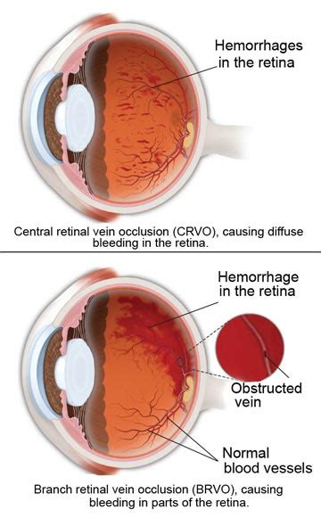 Retinal Vein Occlusion South Bay Ophthalmology