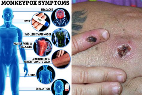 The 8 Symptoms Of Monkeypox You Need To Know The Scottish Sun