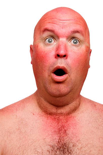 4000 Sunburn Man Stock Photos Pictures And Royalty Free Images Istock