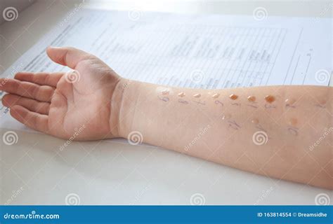 Pediatric Allergy Skin Test Stock Image 163814635