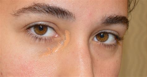 Yellow Discoloration Of Skin Around Eyes
