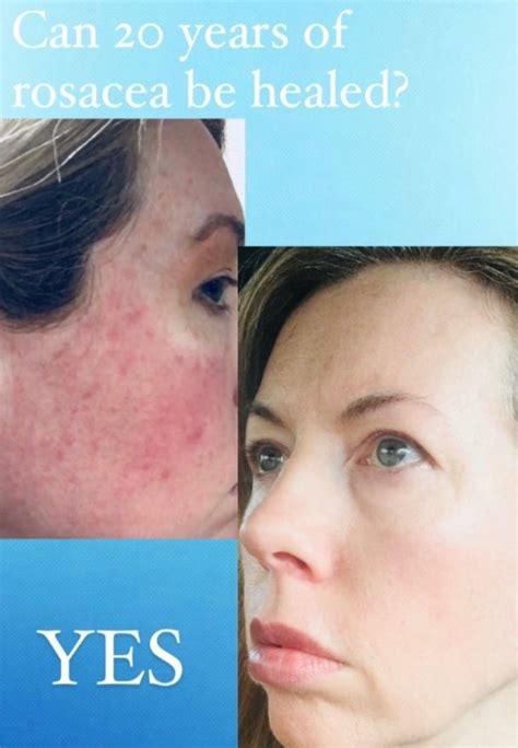 The Rosacea Method Learn The Underlying Causes Of Rosacea