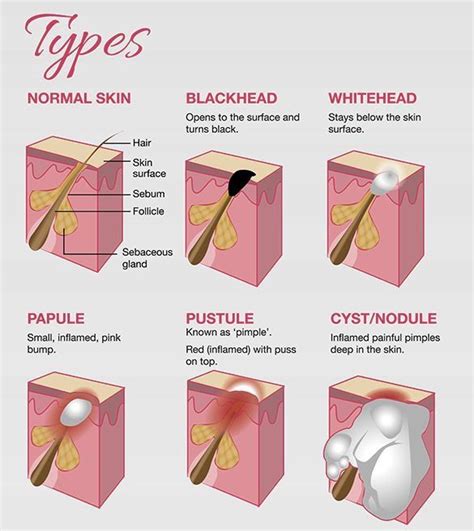 Pin By Lola Gameplay On Aesthetics Types Of Acne Skin Facts Acne