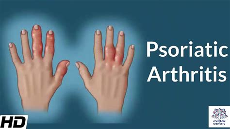 Psoriatic Arthritis Causes Signs And Symptoms Diagnosis And Treatment Youtube