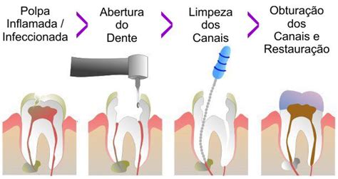 Tratamento De Canal Trindade Odontologia