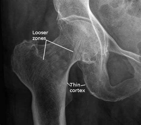 Figure Osteomalacia Hip Joint Image Courtesy S Bhimji Md