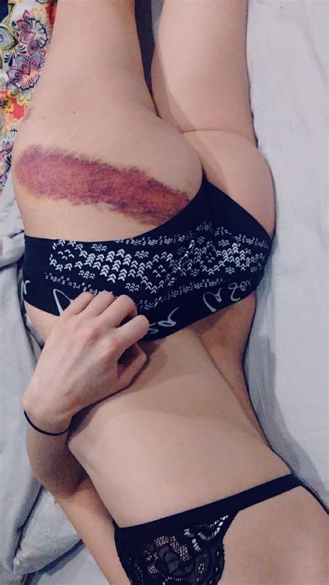 F My Bruise Was So Pretty Porn Pic Eporner