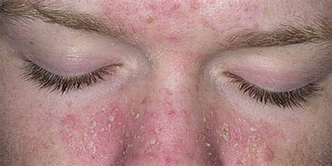 Dermatite Seborreica O Que Causas Sintomas E Tratamento Cl Nica The