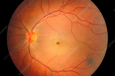 Occlusion Of The Central Retinal Artery Fundus Image Stock Image