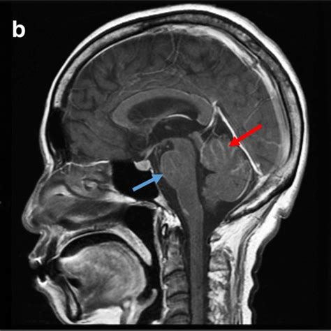 Lmc In Contrast Enhanced Mria Cranial Nerve Enhancement B Folia