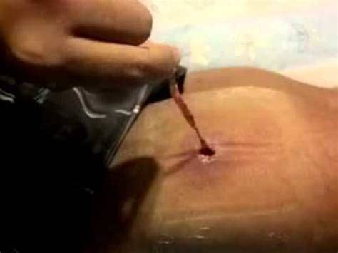 Other common areas for ingrown hairs are the armpits, pubic area and legs. Infected ingrown hair - YouTube