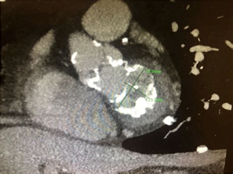 Cardiac Gated Ct Demonstrating Severe Mitral Annular Calcification With