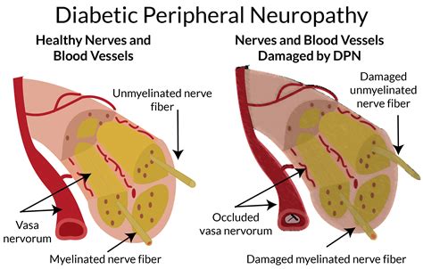 Diabetic Peripheral Neuropathy Highlands Foot And Ankle