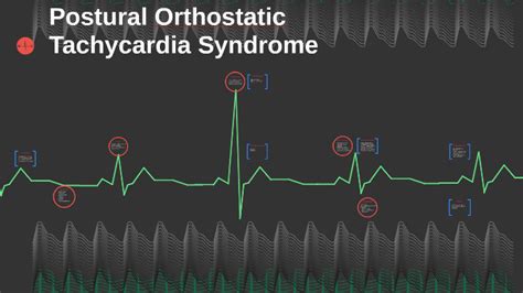 Postural Orthostatic Tachycardia Syndrome By Bailey Peterson