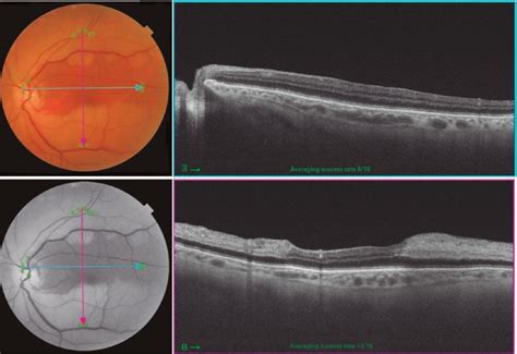 Scielo Brasil Optical Coherence Tomography Oct Angiography Of