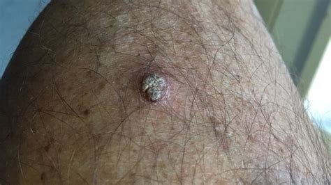 Squamous Cell Carcinoma Scc Pictures Cancer Photos Dermatology