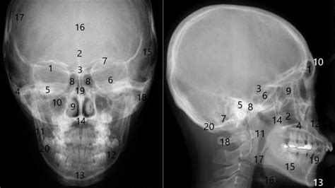 Atividade Sobre Estruturas Da Face Nos Rx Anatomia Radiol Gica