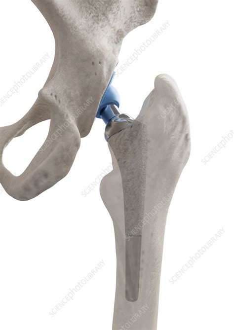Hip Replacement Artwork Stock Image C052 3633 Science Photo Library