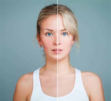 Dermatologist Explains How To Reduce Redness On The Face