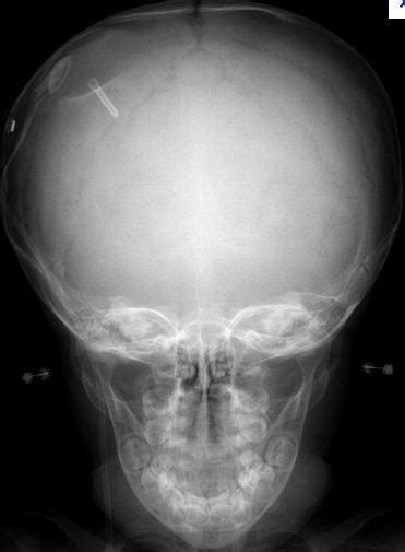 If the goal is to diagnose any problems affecting sinuses or. Radiographic positioning: SKULL