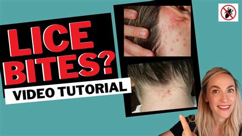 Lice Bites And Rashes Video Tutorial My Lice Advice