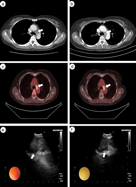 Prognosis Of Multi‐level N2‐positive Non‐small Cell Lung Cancer