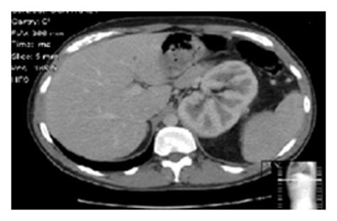 Ct Scan A Axial View At L3 Showing The Distinct Peripheral