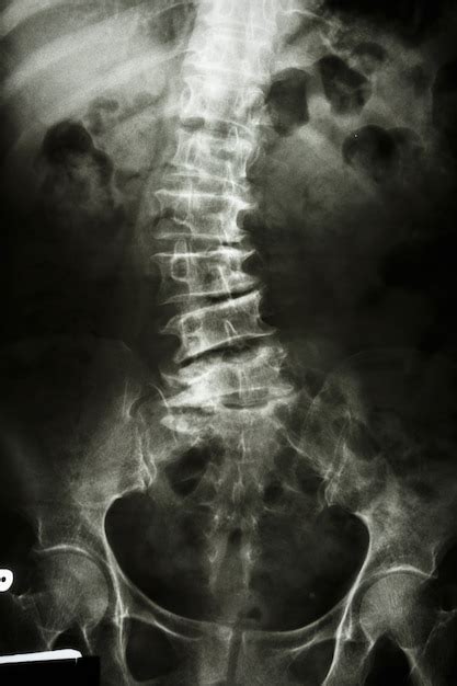 Escoliosis Radiografía De La Película De La Columna Lumbar Vista