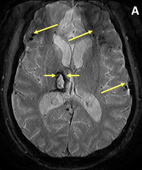 Diffuse Axonal Injury Dai Diagnosis Mri Online