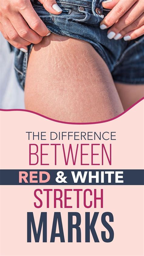 Healthy Tips Healthy Weight White Stretch Marks Article On Women