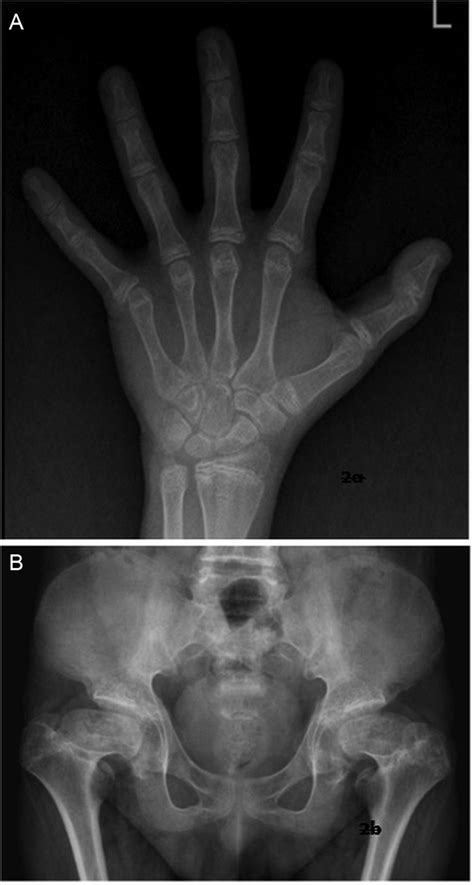 Cretinism Presenting As A Pseudotumour Bmj Case Reports