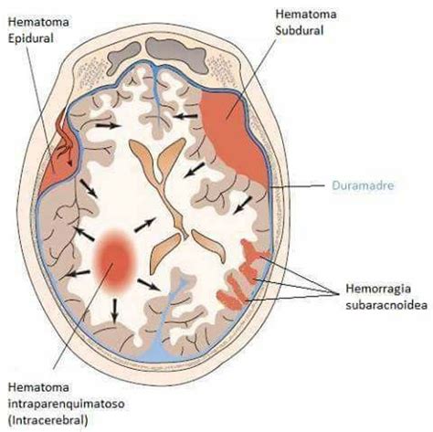 Hematomas Medical Illustration Medical Knowledge Medical Anatomy