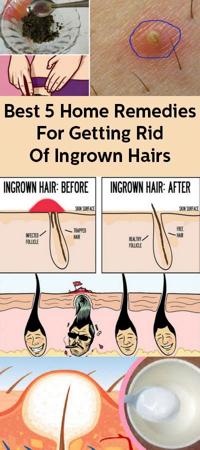 Best 5 Home Remedies For Getting Rid Of Ingrown Hairs Permanentfacialhairremoval In 2020