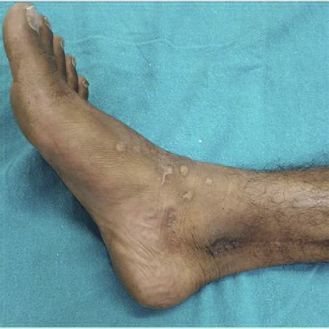 Preoperative Picture Showing Foot Drop Following Common Peroneal Nerve