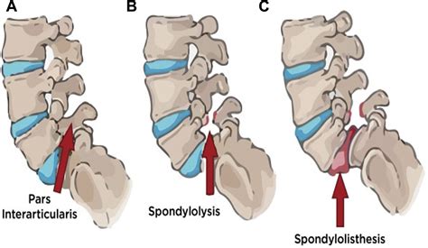 Surgical Treatment Of Lumbar Spondylolisthesis In The Elderly
