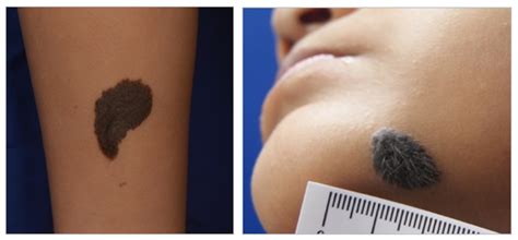 Birthmarks In Children Can They Be Removed Kids Clinic Singapore