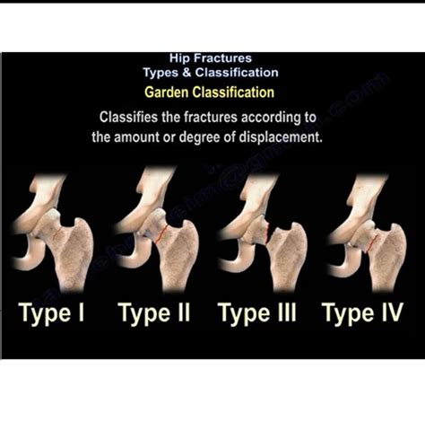 Hip Fractures Types And Classifications —