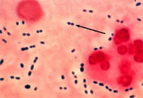 Neisseria meningitidis gram stain streptococcus pneumoniae gram stain neisseria meningitidis shaken baby syndrome haemophilus influenzae. Med Micro 3 - Microbiology 1 with Singh at Michigan State ...