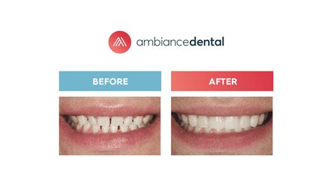 What Are The Elements Of The Perfect Smile Ambiance Dental