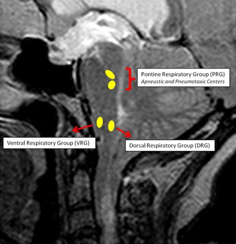 Sagittal T2 Weighted Mri Showing A Case Of Tonsillar Herniation