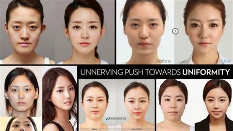 South Korea Has The Best Plastic Surgeons With Amazing Before And After