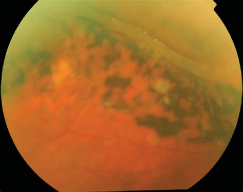 Retinal detachment is a sight threatening condition with an incidence of approximately 1 in 10000. Giant retinal tear developing in a patient of the PLT ...