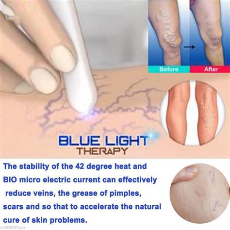 Winners of the patients' choice award, our experts have undertaken over 40,000 procedures. Spider Veins Removal Pen - Blue Light Therapy Laser Pen ...