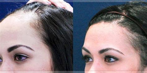 Rarely, laser hair removal can cause blistering, crusting, scarring or other changes in skin texture. Laser Hair Removal Hairline Before After - 214 Best hair ...