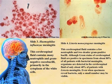 Cns Infections Siddiqui